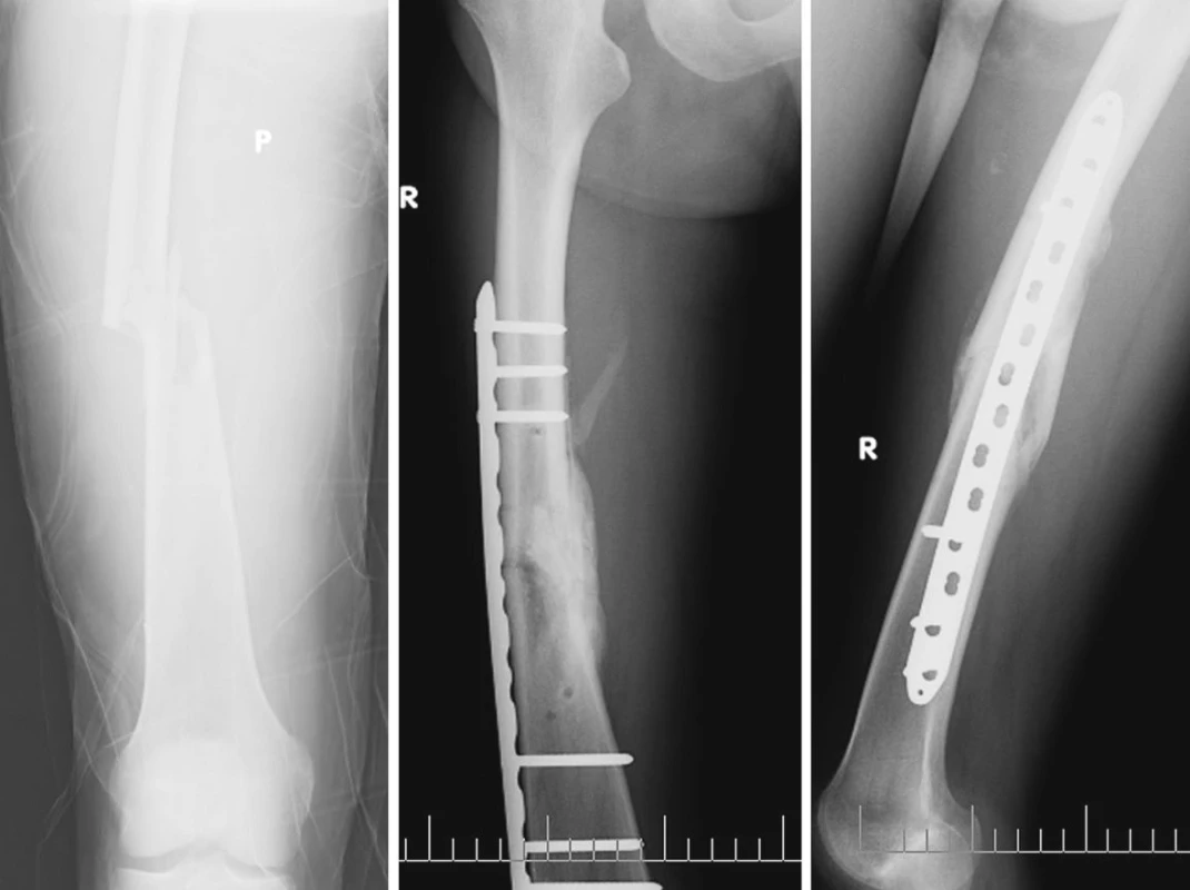 Zlomenina diafýzy femuru vpravo, osteosyntéza dlahou
