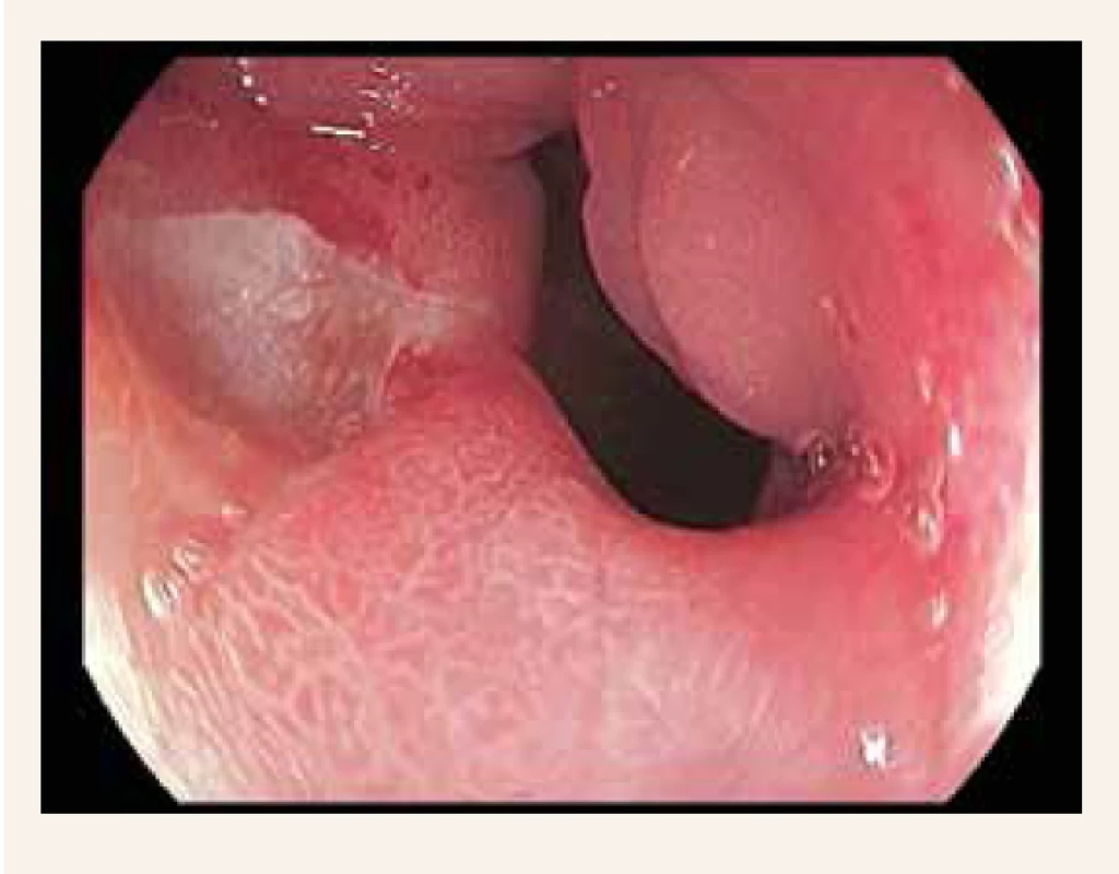 Gastroskopický obraz – Crohnova choroba
v oblasti pyloru