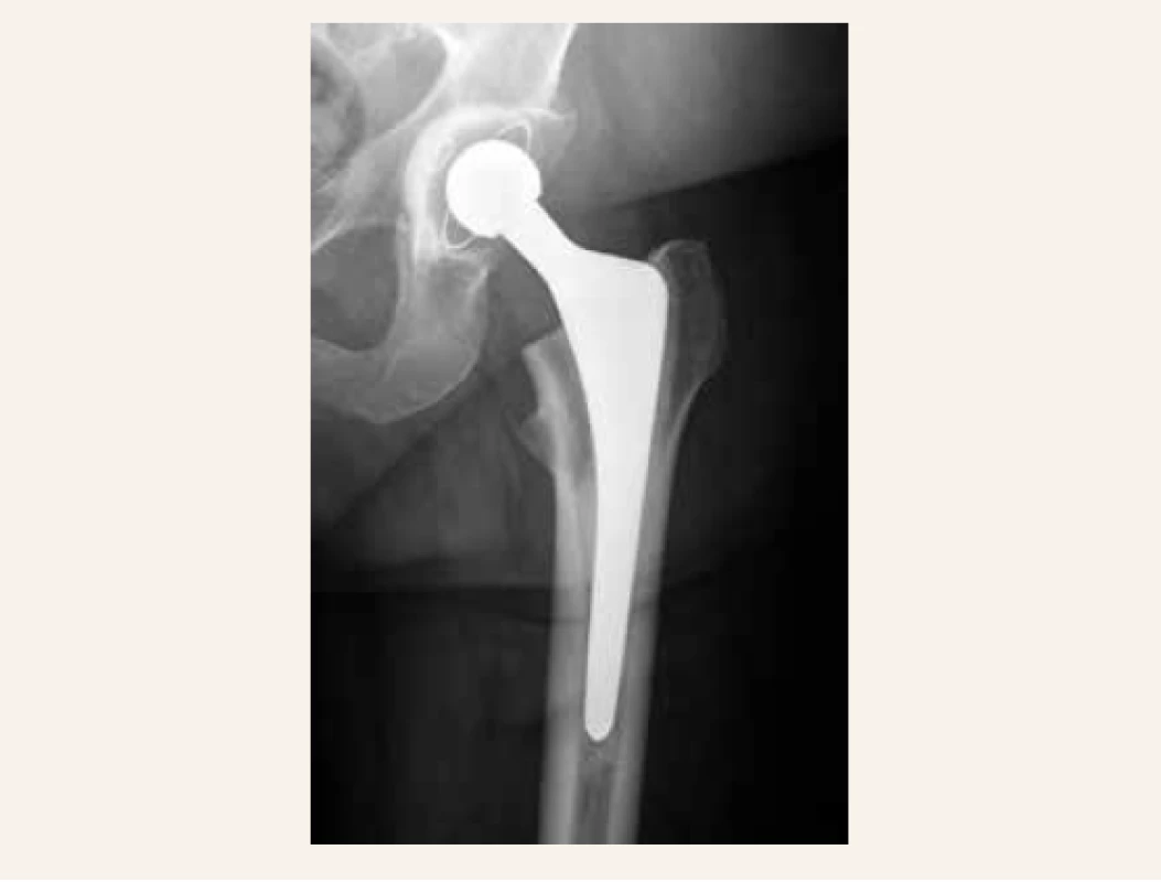 Cementovaná totálna endoprotéza
pri zlomenine krčka stehnovej kosti