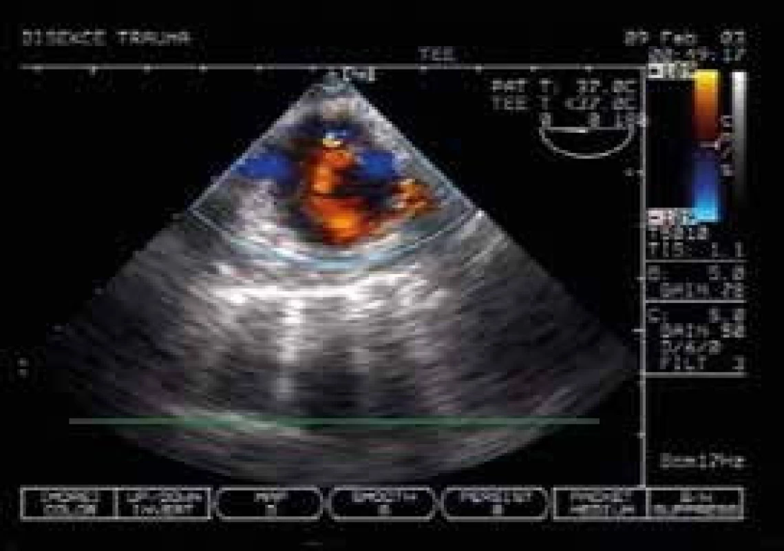 Vyšetření TEE: příjem pacienta s polytraumatem
– v mediastinu nejasný stín a na CT
rozšíření aorty. Na TEE je patrna v levé dolní
části (z pohledu pacienta) sektoru barevného
dopplerovské sonografie traumatická disekce
sestupné aorty s pravým lumen, turbulence
v horní části je vstup do falešného lumen.
Pacient podstoupil urgentní stenting