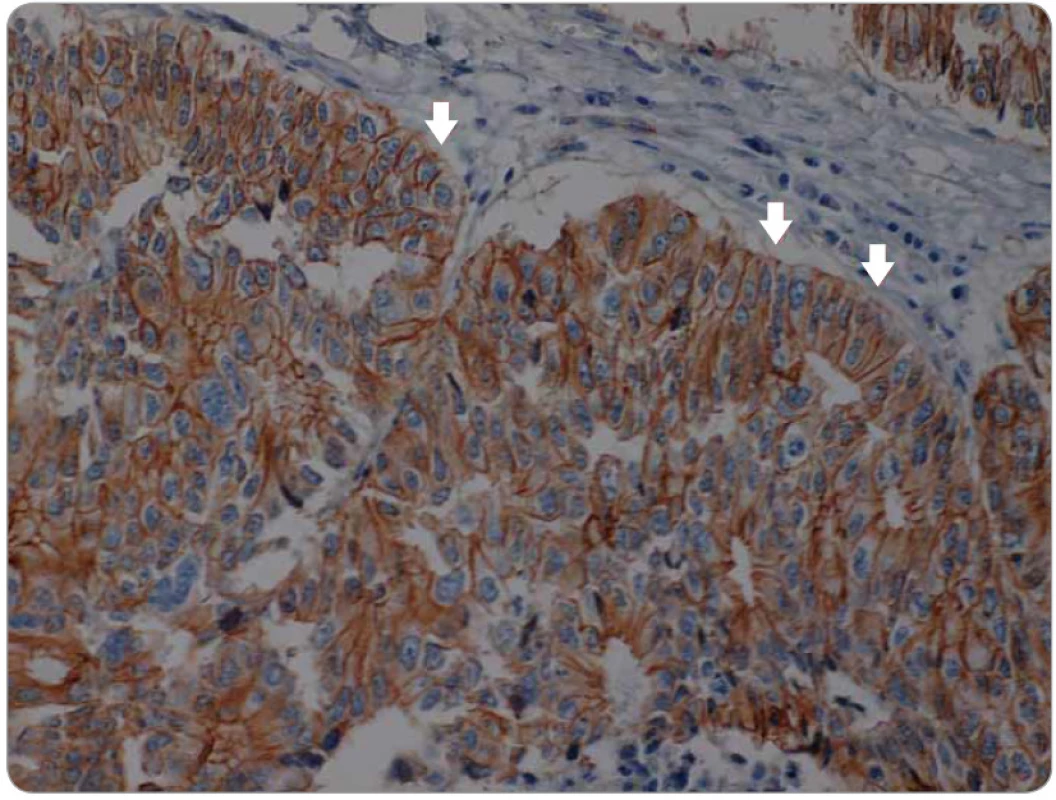 Membránová exprese β-cateninu v nádorové tkáni kolorektálního karcinomu centrální části tumoru. Minimální jaderná exprese (šipky).