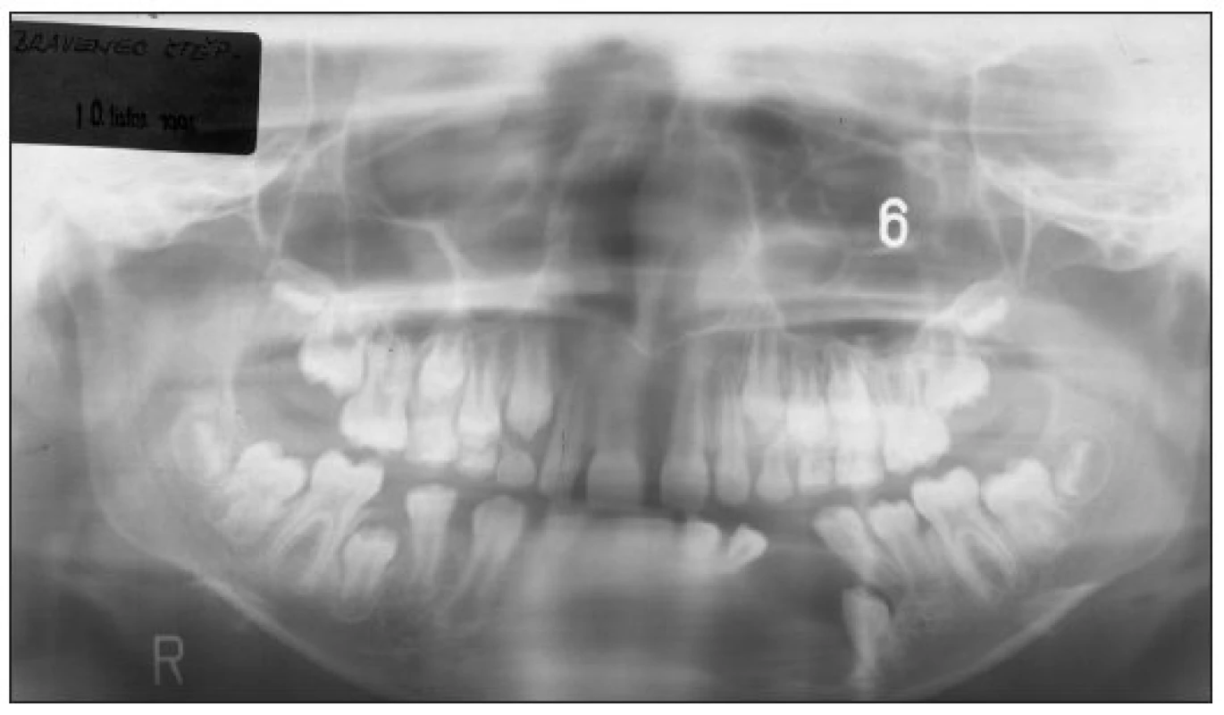 A 9-year-old boy with an aggressive CGCG of the mandible