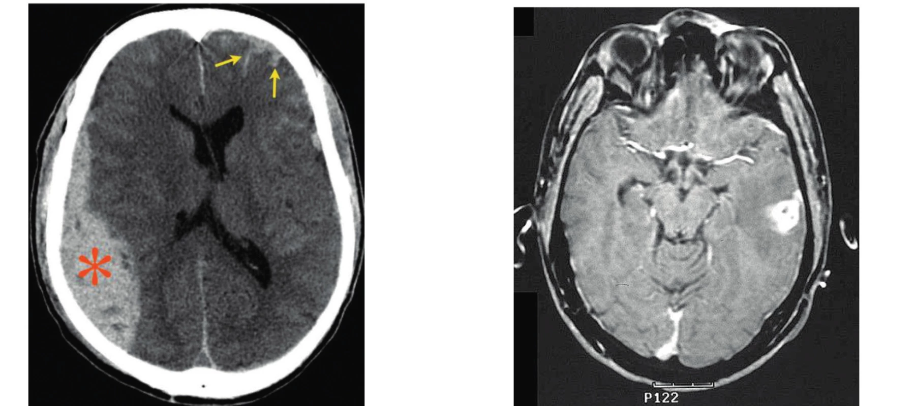 Ilustrační ukázka CT (subdurální hematom*, kontuze→) a MR mozku u traumat