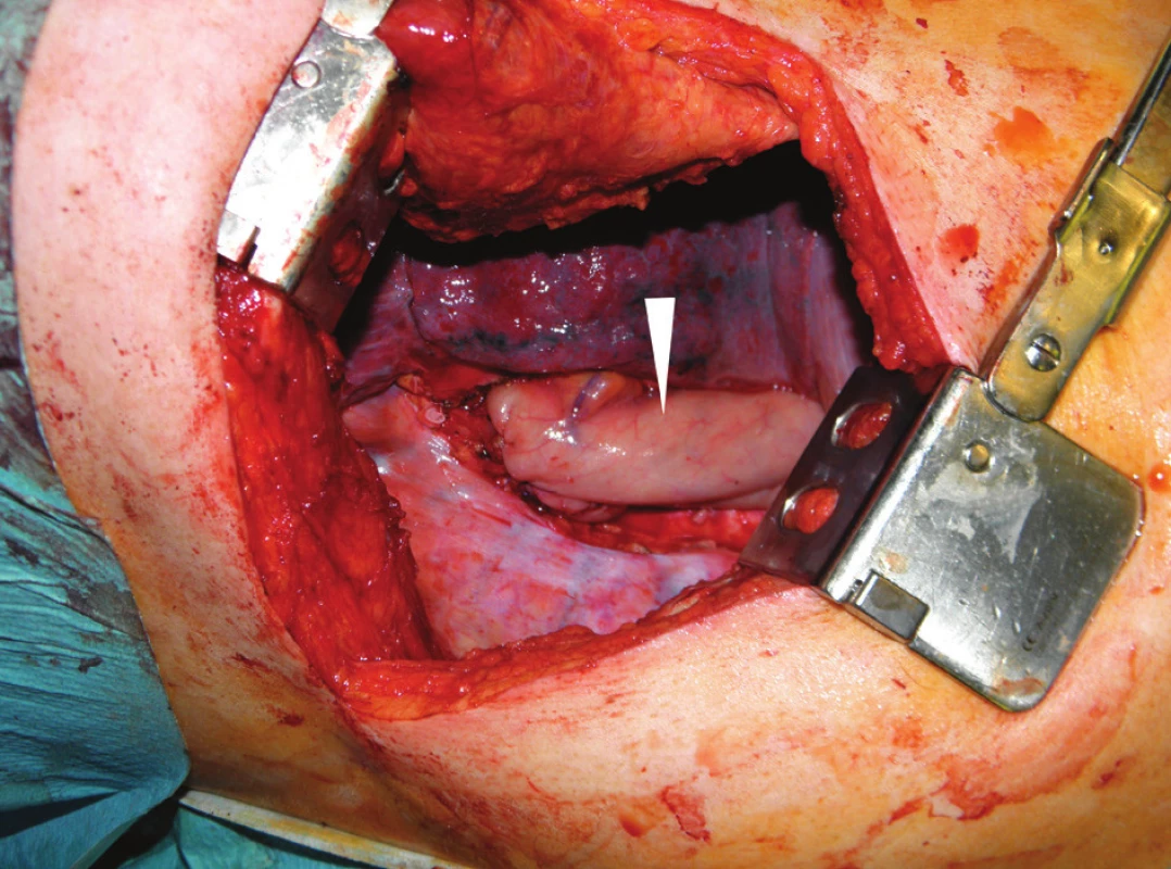 Operační nález při pravostranné thorakotomii: tubulizovaný žaludek (bílá šipka) jako náhrada jícnu po dokončení anastomózy