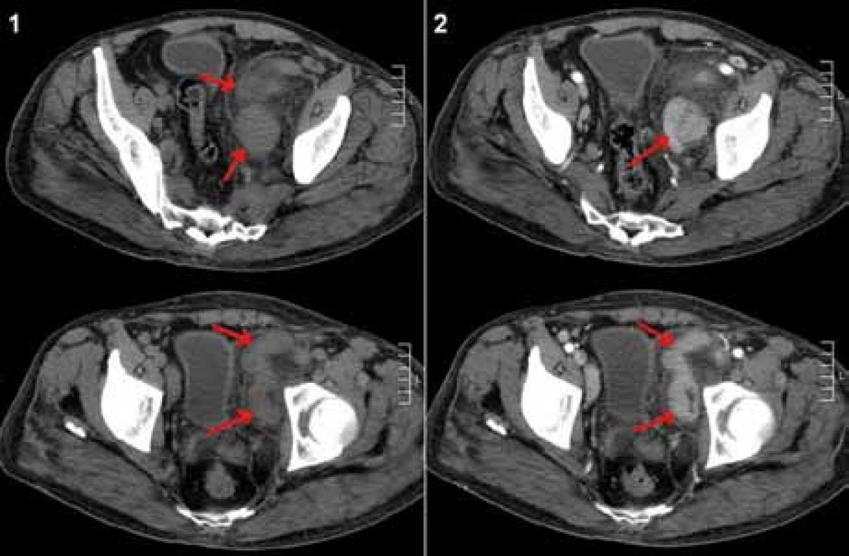 CT břicha, vstupní vyšetření – říjen roku 2008. Paket uzlin parailicky vlevo (šipky), nativní vyšetření (1) a po aplikaci kontrastní látky (2), kde je patrné homogenní sycení uzlin kontrastní látkou.