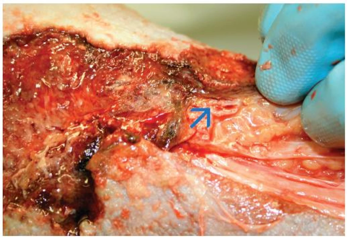 Po preparaci měkkých tkání byla na spodině horní části defektu nad vnitřním kotníkem pravé nohy zjištěna otevřená žilní stěna jedné z větví velké zjevné žíly – zdroj akutního krvácení (šipka).