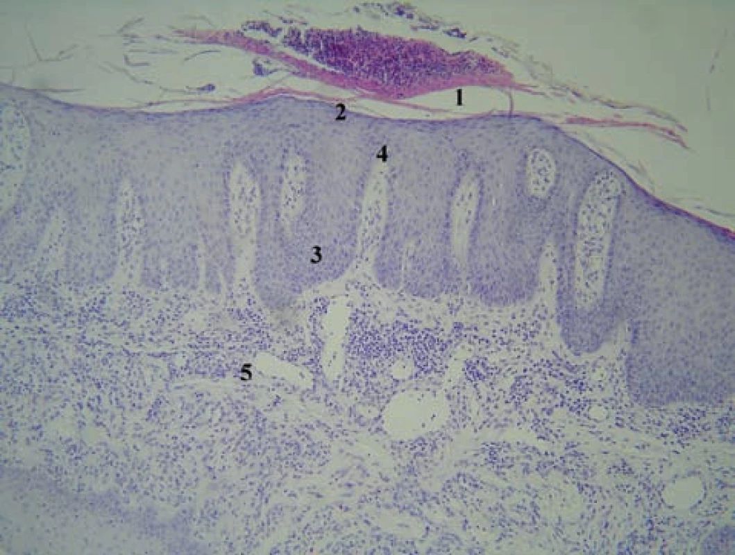 Histologický obraz rozvinutej lézie psoriaziformnej erupcie u pacienta liečeného infliximabom z indikácie hidradenitis suppurativa (HE, 200 x)
1 – parakeratóza masívne infiltrovaná imigrovanými neutrofilmi: veľký Munroov mikroabsces, 2 – hypogranulóza s fokálnou agranulózou, 3 – prstovitá (psoriaziformná) akantóza, 4 – papilomatóza s dilatovanou kapilárou a lymfocytovým infiltrátom, 5 – dilatované kapiláry a neobvykle hlboko penetrujúce lymfohistiocytové infiltráty s prímesou eozinofilov