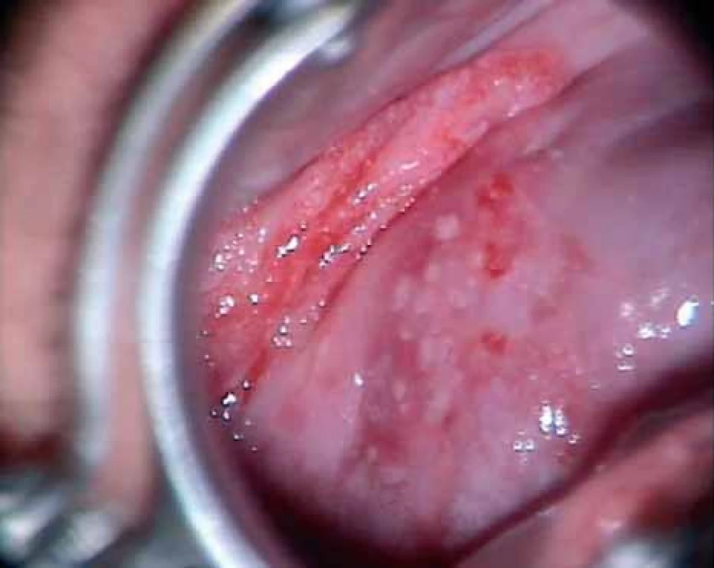 Vaginální intraepiteliální neoplazie - VaIN III.