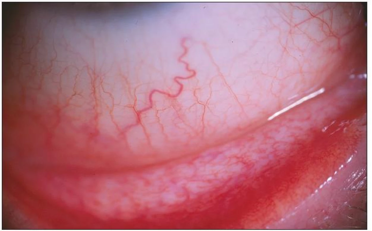 Pacient č. 1: střední klinický nález – zduření dolního fornixu s mírnou vinutostí cév bulbární spojivky a náznakem hyperémie