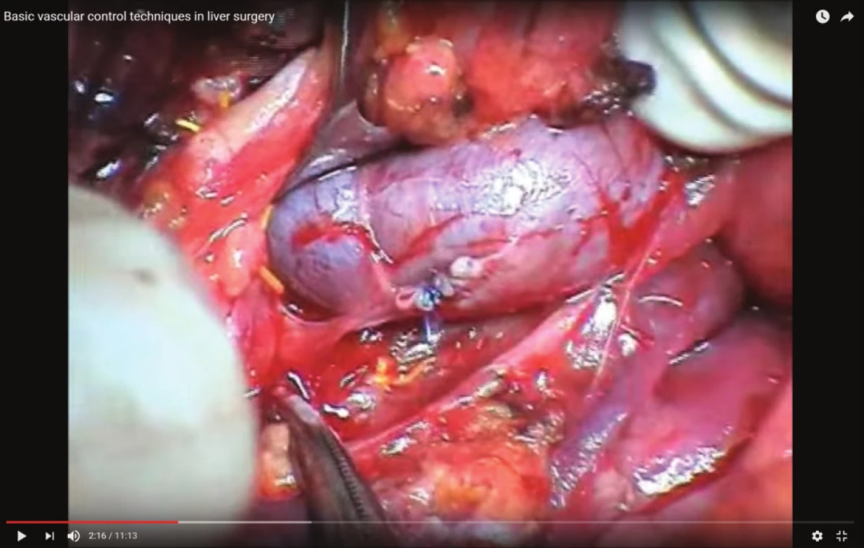 Sutura levé jaterní žíly
Fig. 3: Left hepatic vein suture