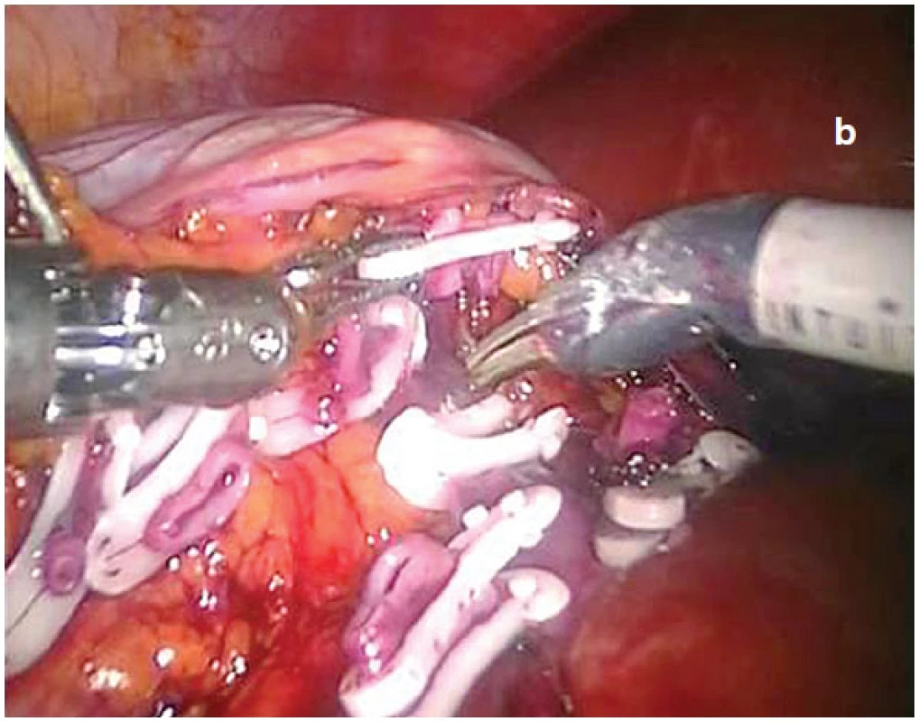 Využití daVinci&lt;sup&gt;®&lt;/sup&gt; robotické nefrektomie pro komplikovaný případ RCC s vícečetným anomálním cévním zásobením postižené ledviny Technika laparoskopické daVinci&lt;sup&gt;®&lt;/sup&gt; roboticky asistované pravostranné nefrektomie pro karcinom pravé ledviny se dvěma renálními tepnami a žílami se zachováním tradičního operačního principu radikálního uroonkologického postupu. V první fázi jsou preparovány a mezi bezpečnostními zamykatelnými Hemolock&lt;sup&gt;®&lt;/sup&gt; klipy (a) nejprve přerušeny obě renální tepny. Následuje obdobné ošetření a ostré přerušení obou renálních žil při jejich odstupu z vena cava interiér (b), kdy centrální pahýl všech magistrálních cév bezpečně zajištěn dvěma naloženými Hemolock&lt;sup&gt;®&lt;/sup&gt; klipy. Dokončení výkonu, kdy mezi Hemolock klipy jsou již ostře přerušeny obě renální tepny a žíly. Před ukončením výkonu zůstává laterálně od vena cava inferior ve spodině patrný pouze musculus psoas (foto z operačního videa).