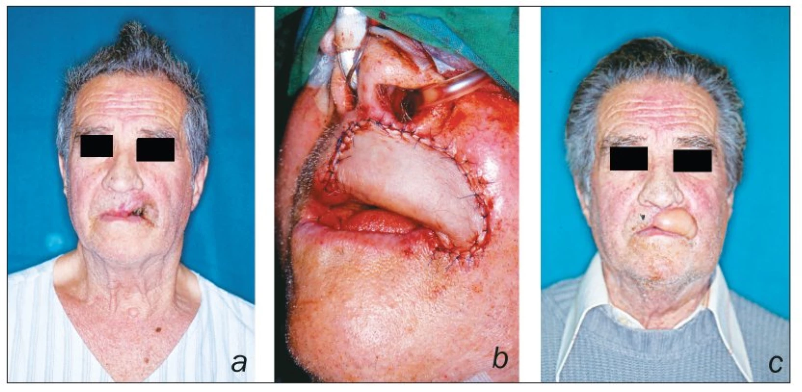 Patient presented with large basal cell carcinoma of the upper lip (a); after insetting of radial forearm
flap (b); postoperative result (c)