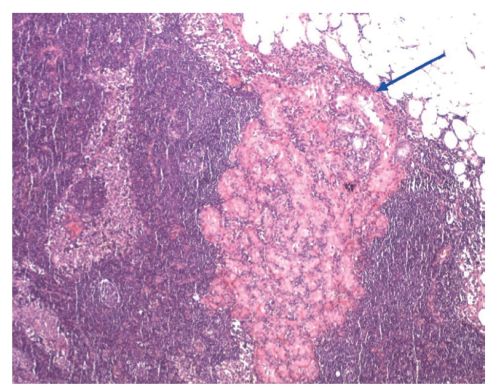 Metastáza MPTC v lymfatické uzlině<br>
Fig. 2: MPTC metastasis in lymph node