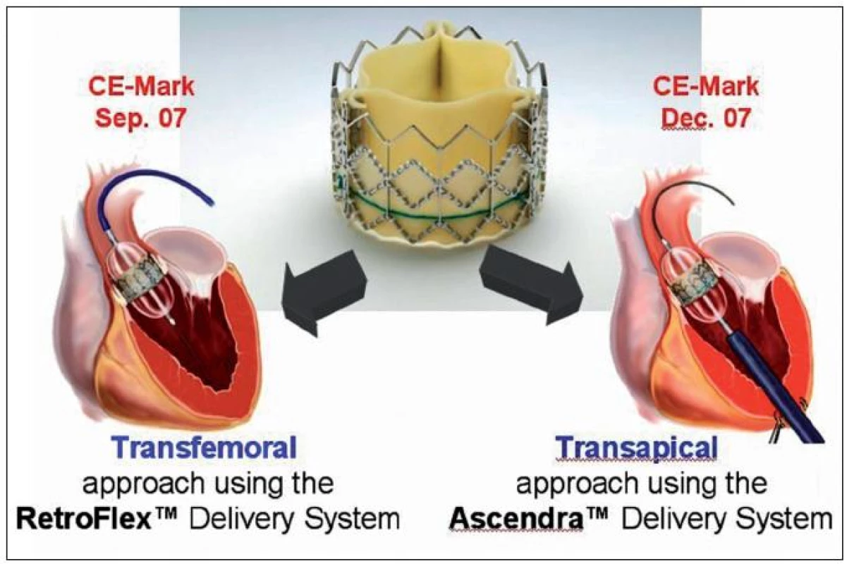 Chlopeň typu Sapien-Edwards a dvě přístupové cesty k implantaci: transfemorální a transapikální přes hrot levé komory