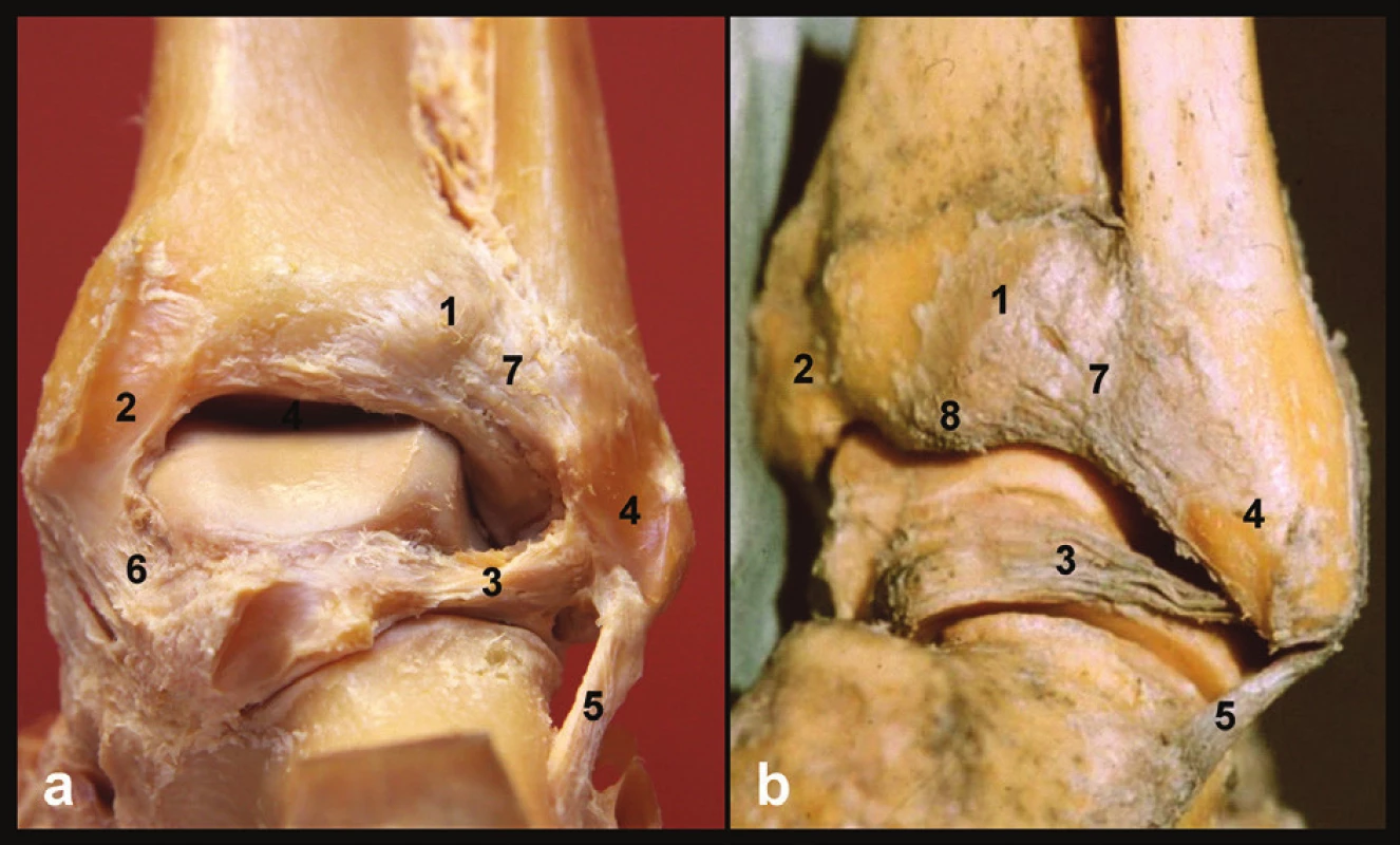 Anatomie zadní hrany tibie, pravé hlezno
a – pohled zezadu, b – pohled posterolaterální, 1 – tuberculum posterius tibiae, 2 – sulcus tendinis m. tibialis posterior, 3 – lig. talofibulare posterius, 4 – sulcus malleoli lateralis, 5 – lig. fibulocalcaneare, 6 – tibio-talární část deltového vazu, 7 – lig. tibiofibulare posterius, 8 – zadní malleolus. Převzato z [11].
Fig. 1: Anatomy of posterior tibial rim, right ankle
a – posterior view, b –posterolateral view, 1 – tuberculum posterius tibiae, 2 – sulcus tendinis m. tibialis posterior, 3 – lig. tibiofibulare posterius, 4 – sulcus malleoli lateralis, 5 – lig. fibulocalcaneare, 6 – tibio-talar part of deltoid ligament, 7 – lig. tibiofibulare posterius, 8 – malleolus posterior. Courtesy of [11].