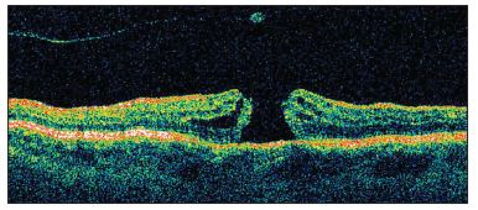 OCT znázorňuje dieru makuly v plnej hrúbke a cystoidným zhrubnutím jej okrajov a podobne ako na predchádzajúcom obrázku zadnú kôru sklovca
