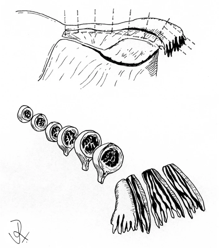 Zpracování děložní tuby podle protokolu SEE-FIM (sectioning and extensively examining the fimbria).