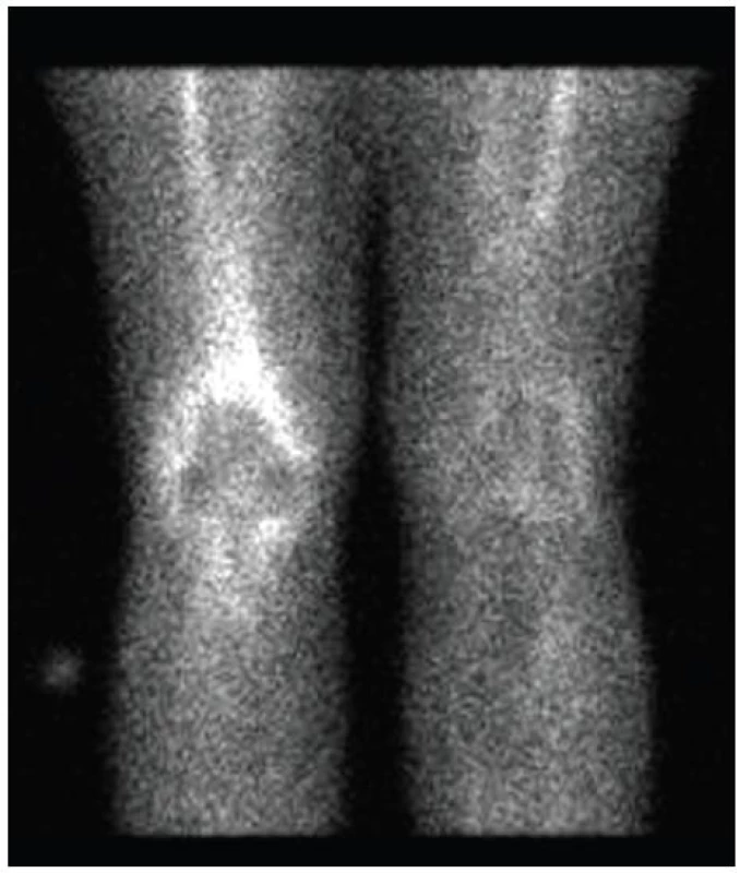Zobrazení kolenních kloubů značeným fragmentem protilátky. Planární obraz, pohled přední. Je patrná akumulace leukocytů v okolí endoprotézy v pravém kolenním kloubu. Bílý bod v levé části obrazu je zářič označující pravou končetinu.