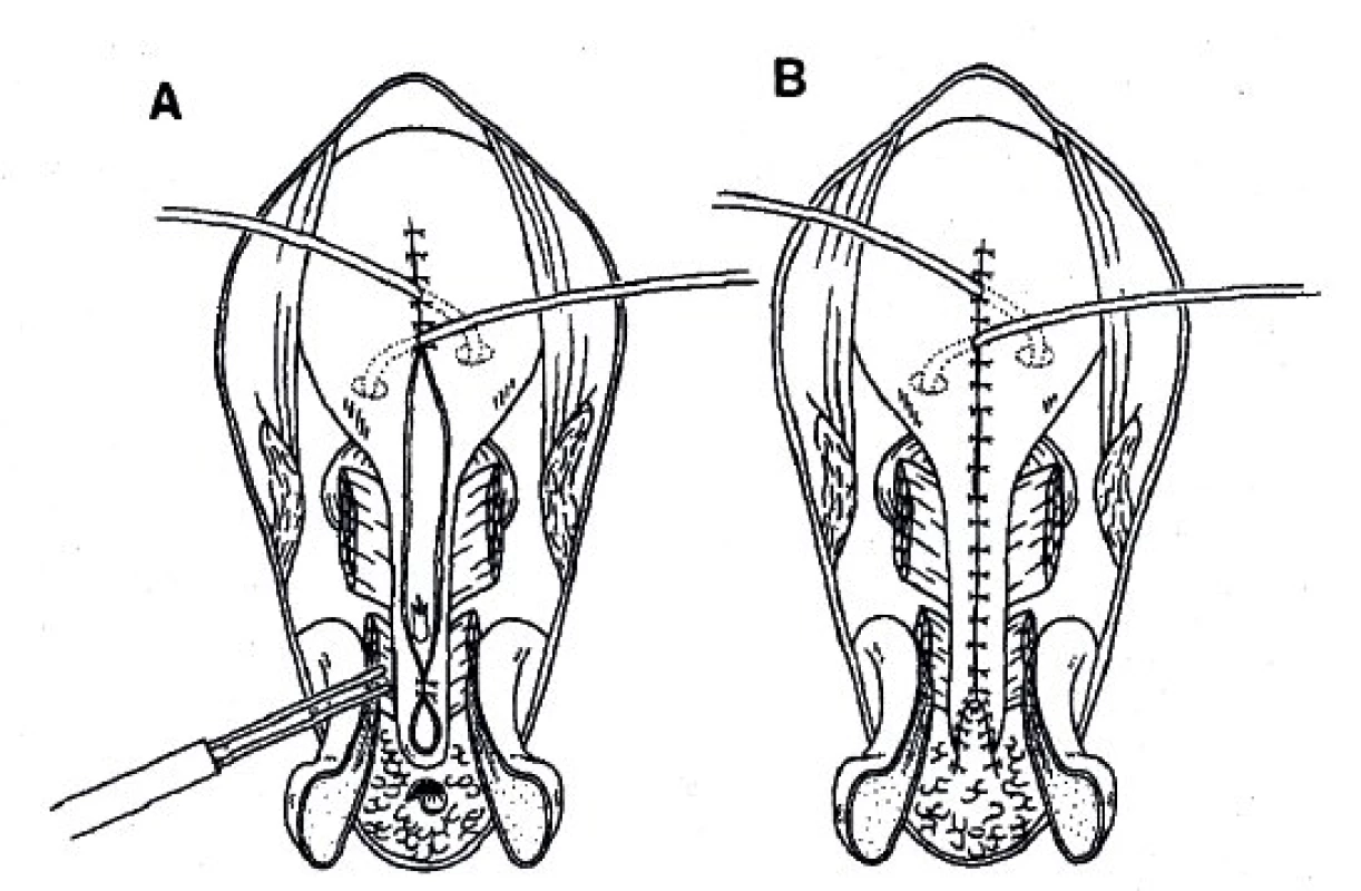 Dokončení plastiky dle Kellyho s rekonstrukcí glandu a kavernózních těles.
Fig. 7. Reconstruction of the glans and cavernous bodies - terminal phase of the operation.