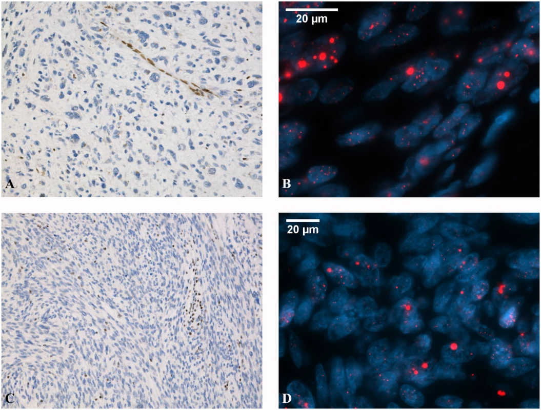 Representative images of ATRX and DAXX expression and ALT phenotype in ULMS.