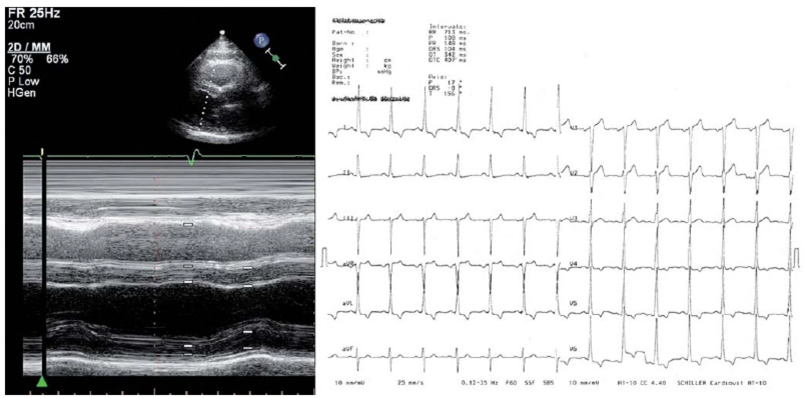 Příklad hodnocení echokardiografického záznamu s hodnocením síly stěn LK a EKG křivka téhož nemocného