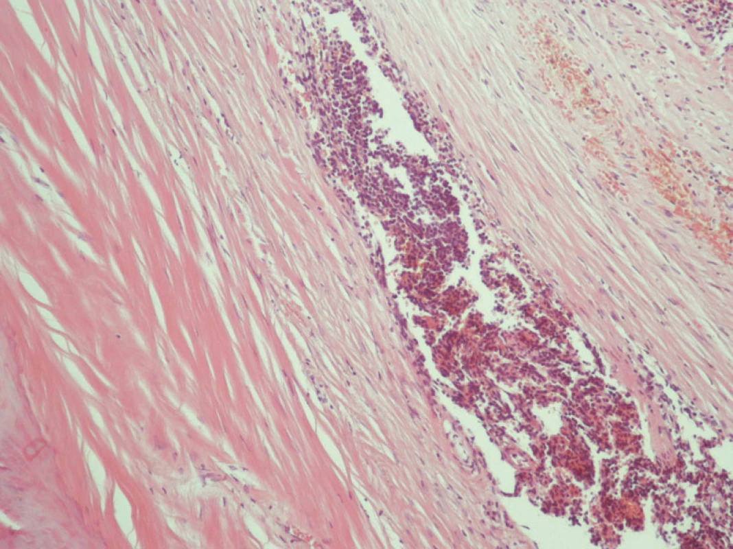 Pseudocysta sleziny v histologickém obrazu
Fig. 6. Histology of the pseudocyst of the spleen