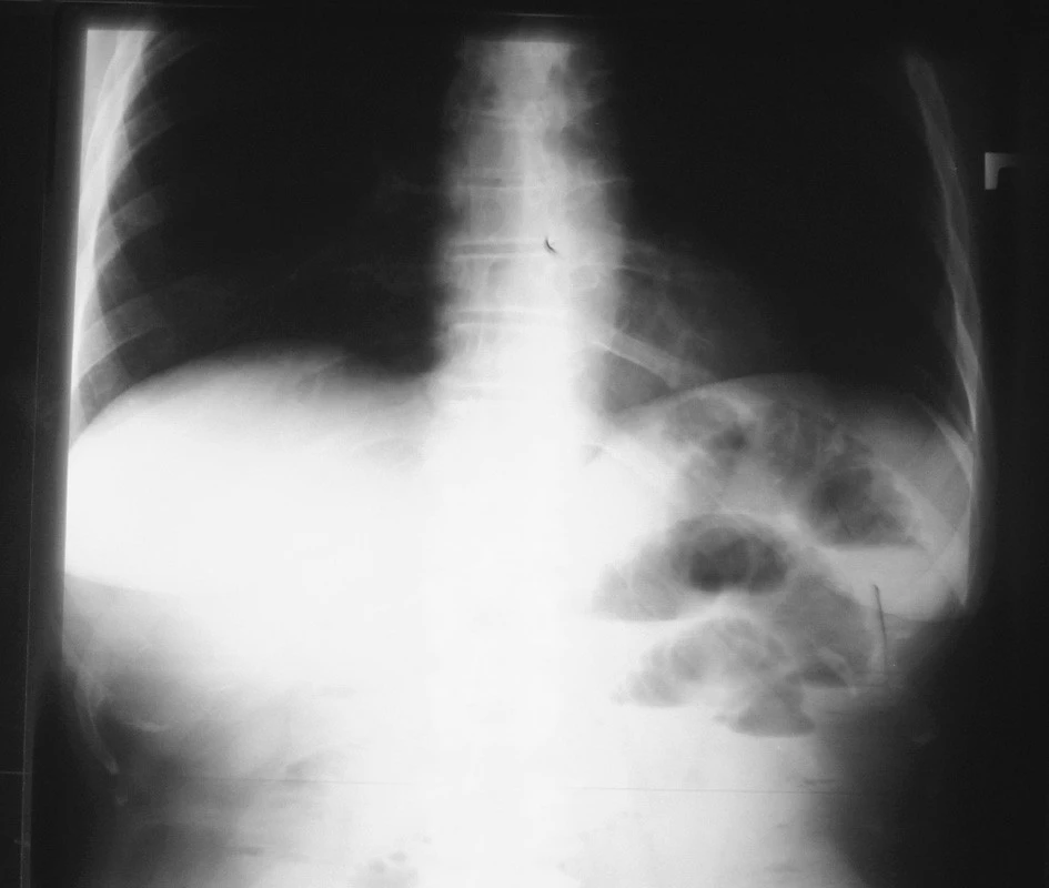 NSB postojačky 15. 4. 2007 = pri prijatí
Fig. 1. Upright native abdominal x-ray view – 15-04-2007 =at admission