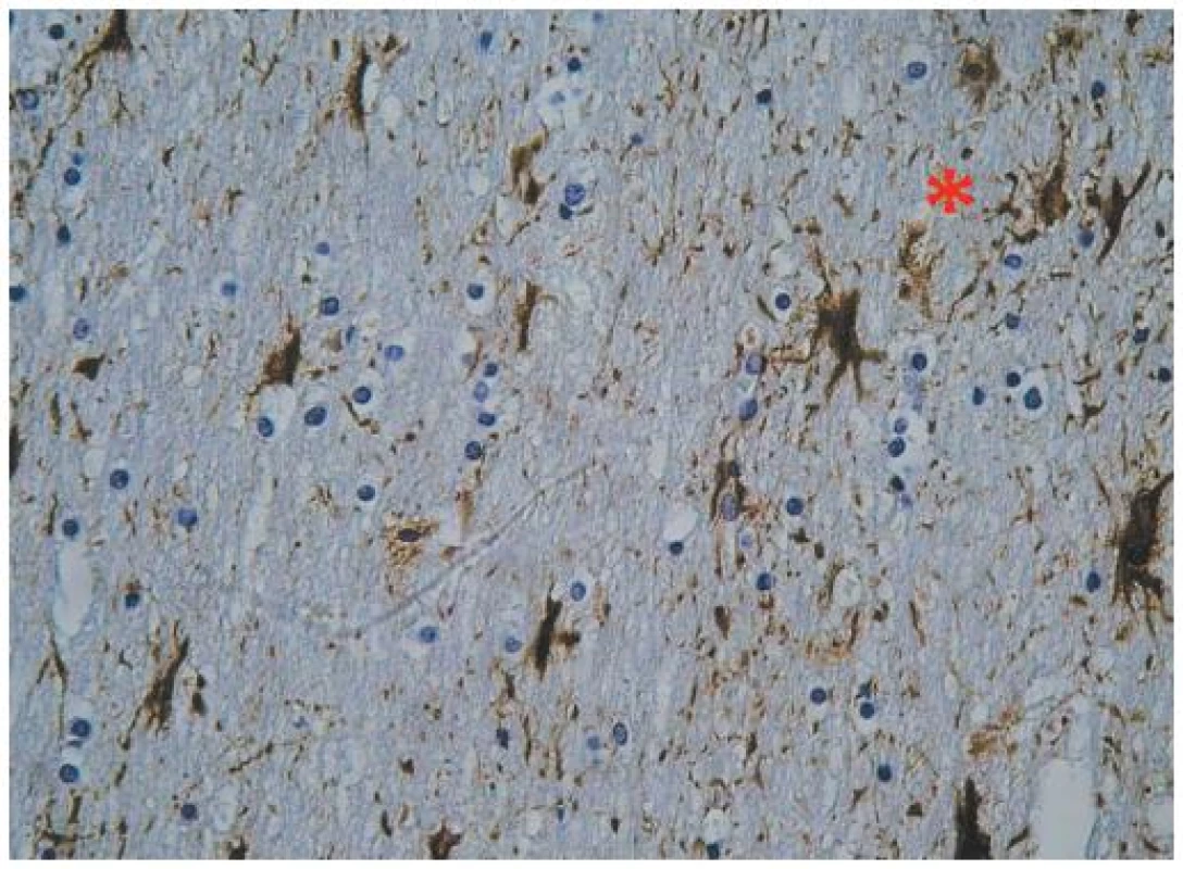 GFAP imunopozitivita fibrilární astroglie v podkorové bílé hmotě. Imunohistochemické vyšetření umožňuje hodnotit nakupení astroglie (astrogliosa označena hvězdičkou). Výběžky astroglie a pozorovatelné kontakty s kapilárním řečištěm i gliovými buňkami (připomínající oligodendroglii s kulatým jádrem). Zvětšení 400x.