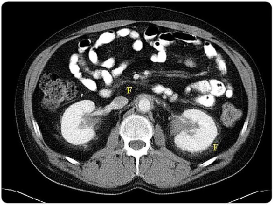 Zobrazení břišní dutiny metodou CT – zřetelná fibróza v oblasti retroperitonea.