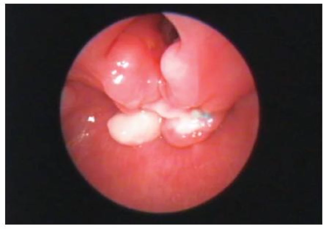 LTER–endoskopie po operaci – před odstraněním uvolněných vrcholků jícnové vrstvy (funkčně bez potíží).