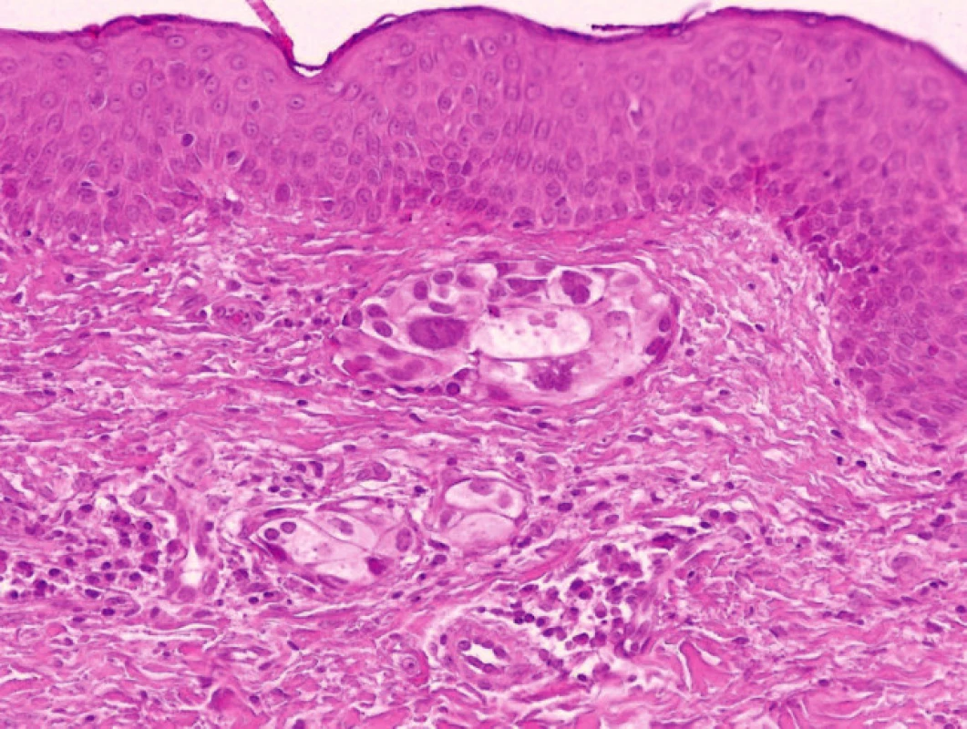 Histologický obraz metastázy karcinomu měchýře, šíření v lymfatických cévách (HE, 100x).
