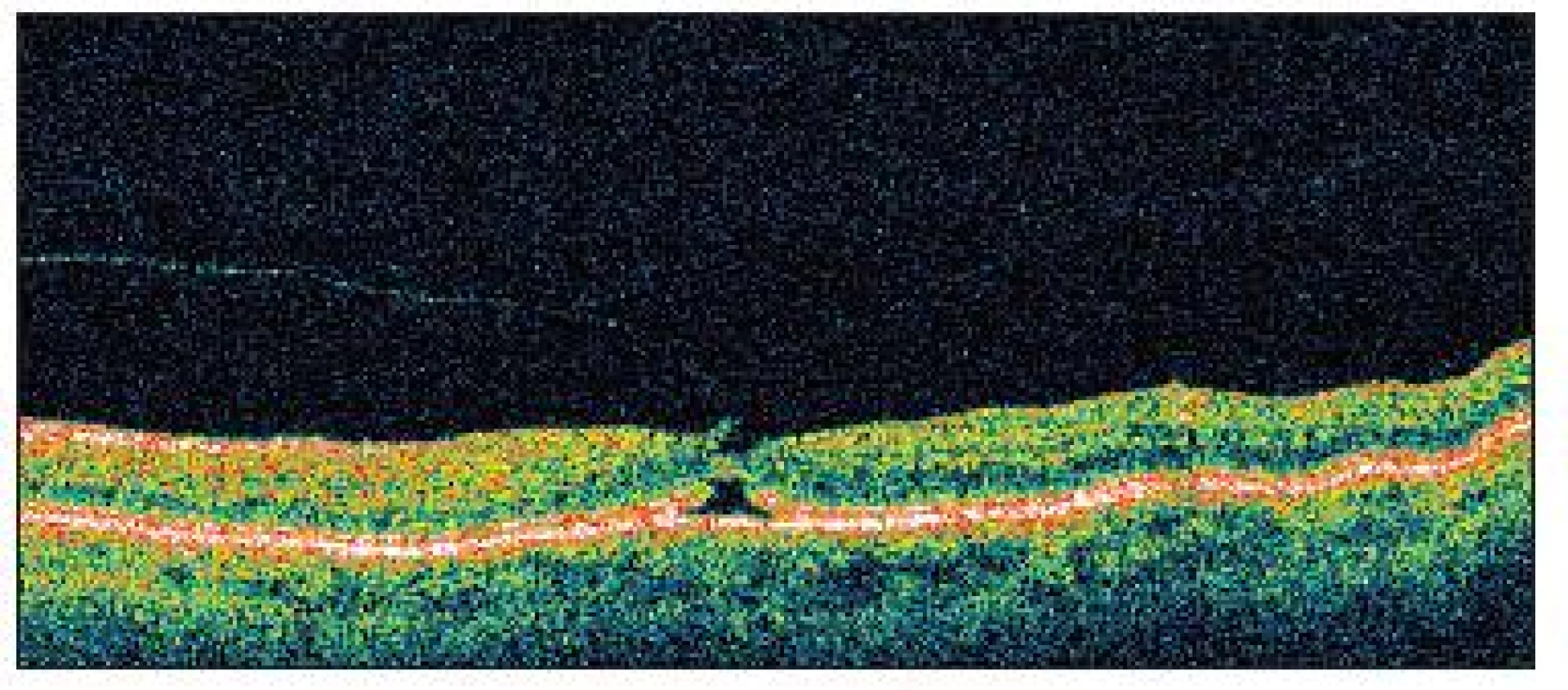 OCT zobrazuje u pacientky č. 2 anomálnu abláciu zadného sklovca v oblasti foveoly s úponom sklovca, ktorý ťahá vytrhnutý prúžok neuroretiny, oploštenie foveálnej depresie a cystoidnú zmenu v hĺbke neuroretiny a tiež narušenie kontinuity vrstvy junkcie fotoreceptorov nad pigmentovým epitelom sietnice