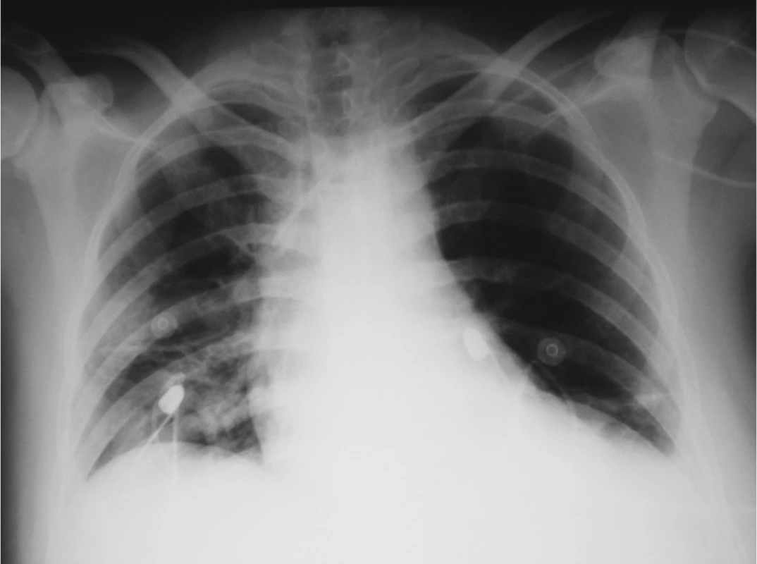 RTG plic – po drenáži obou hemitoraxů
Fig. 4. Pulmonary x-ray – following drainage of the both hemithoraces