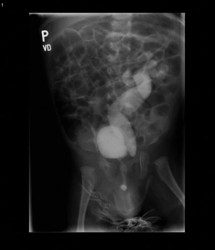 Kazuistika č. 4. Mikční cystografie – vezikoureterální reflux IV. st. vlevo.
Fig. 7. Case report 4. Voiding cystography – vesicoureteral reflux of 4th degree on the left.