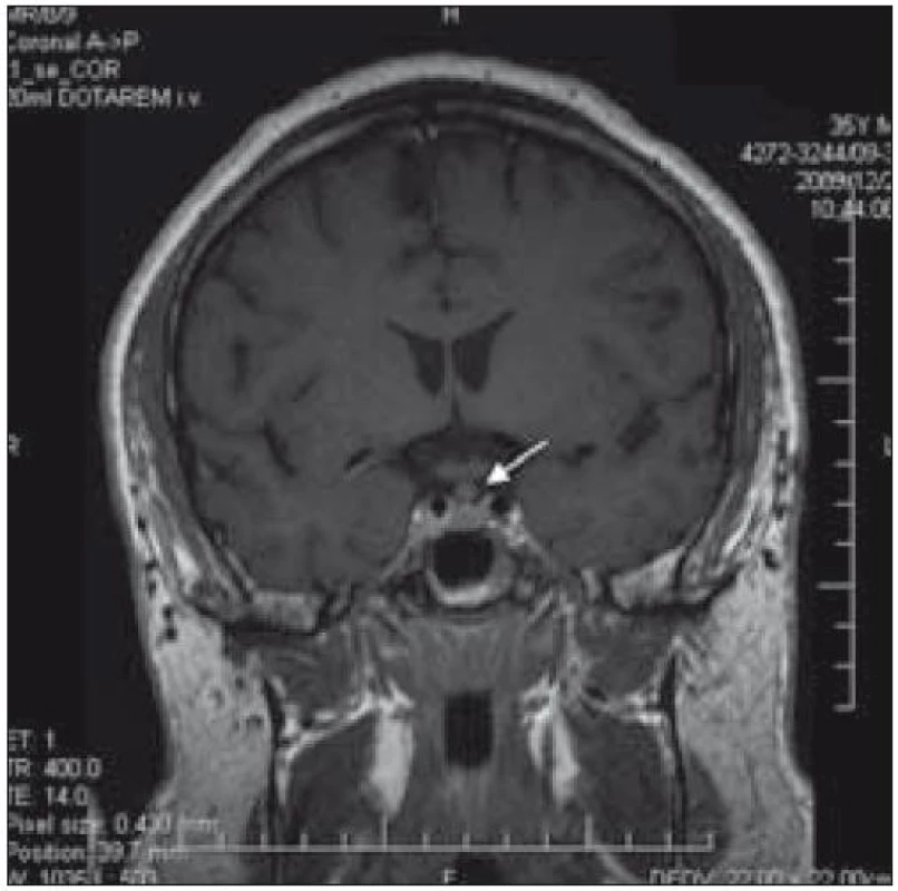 MR mozku, bobulovitě rozšířené infundibulum hypofýzy u pacienta 3.