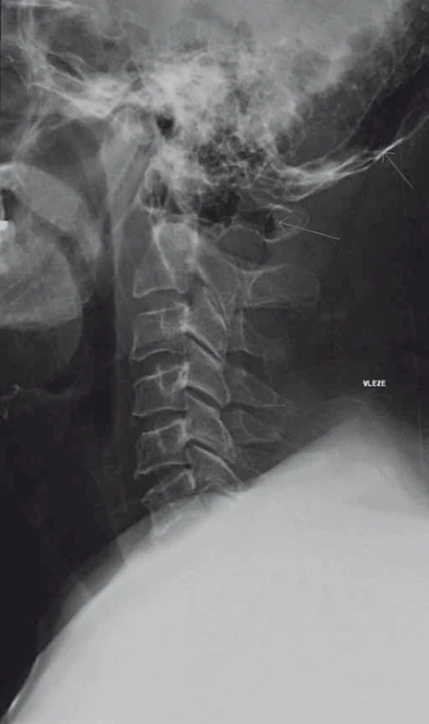 Bočný RTG snímek krční páteře, šipky ukazují na nezvyklý podíl pneumatizace v kostní dřeni okcipitální kosti a C1.