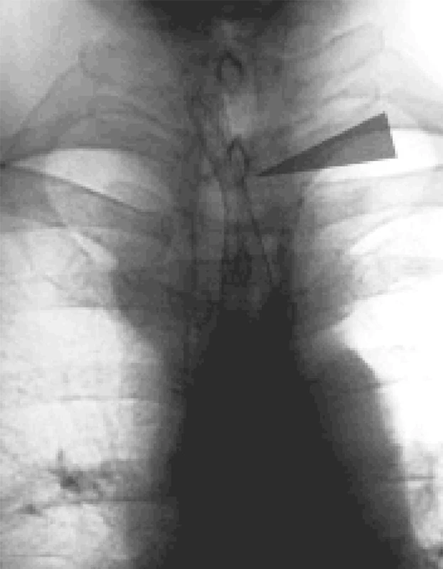 RTG obraz stenózy jícnu ošetřené stentem ELLA
Fig. 5. X-ray view of esophageal stenosis managed with an ELLA stent 