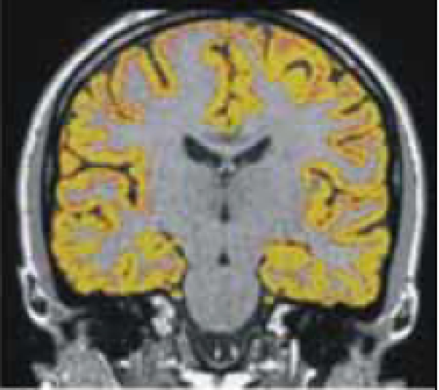 Měření mozkové atrofie pomocí programu SIENA.