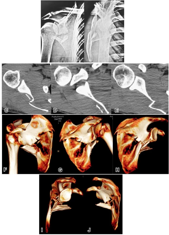 Kompletní radiologické vyšetření u pacienta se dvoufragmentovou zlomeninou těla: A – Neerova I. projekce, B – Neerova II. projekce, C, D, E – příčné CT řezy v proximodistálním pořadí, F – 3D CT rekonstruce, pohled zpředu, G – 3D CT, pohled zezadu, H – 3D CT, pohled zezadu se subtrakcí proximálního humeru, I – 3D CT, pohled z laterální strany se subtrakcí proximálního humeru a klíčku, J – 3D CT, pohled z mediální strany se subtrakcí proximálního humeru a klíčku. Srovnání jednotlivých metod ukazuje, jak zavádějící jsou CT řezy při diagnostice zlomenin těla lopatky. Peroperační nález u tohoto pacienta přesně odpovídal 3D CT rekonstrukci. 
Fig. 3. Complete radiological image in patient with transverse fracture of the scapula body: A – Neer I view, B – Neer II view, C, D, E CT – scans in proximo-distal sequence, F – 3D CT reconstruction, anterior view, G – 3D CT reconstruction, posterior view, H – 3D CT reconstruction, posterior view with subtraction of proximal humerus, I – 3D CT reconstruction, lateral view with subtraction of proximal humerus and clavicle, J – 3D CT reconstruction, medial view with subtraction of proximal humerus and clavicle. Comparison of individual methods shows how misleading the transverse CT scans may be for diagnostics of fracture of scapula body. Intraoperative finding view in this patient corresponded exactly to 3D CT reconstruction.