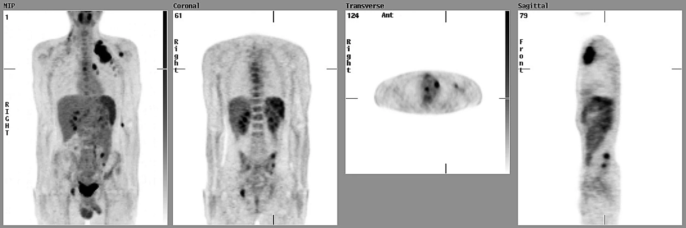 Osmnáctiletý pacient s HD měl podle CT a UZ vyšetření postižené uzliny vpravo na krku, vlevo periklavikulárně a axilárně, infiltrovanou slezinu (stadium III S). PET zobrazila další ložiska v mediastinu, v pravém plicním hilu a víceložiskové postižení skeletu (obratle, pánev) a správně zvýšila klinické stadium na IV S.