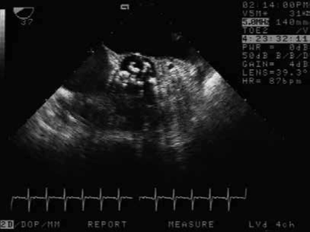 Vyšetření TEE pacientky resuscitované pro
arytmii, příjmové vyšetření odhalilo těsnou
aortální stenózu (AVAi 0,4 cm2). Vyšetření TEE
ze středního jícnu – nahoře levá síň, v centru
těžce degenerovaná aortální chlopeň, která
byla 2. den po příjmu nahrazena protézou