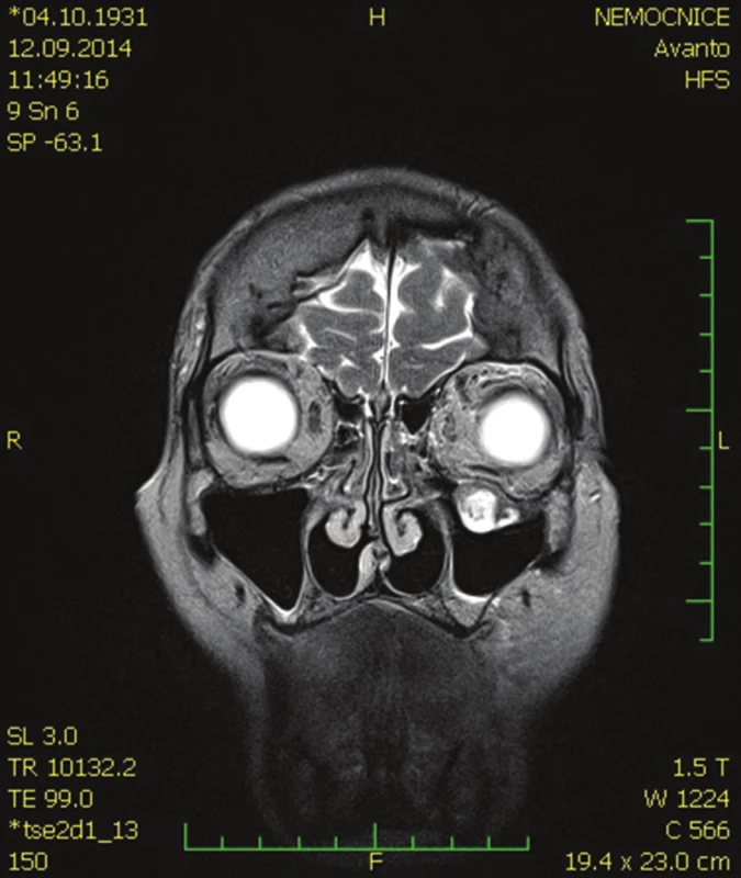 MR hlavy – koronární řez