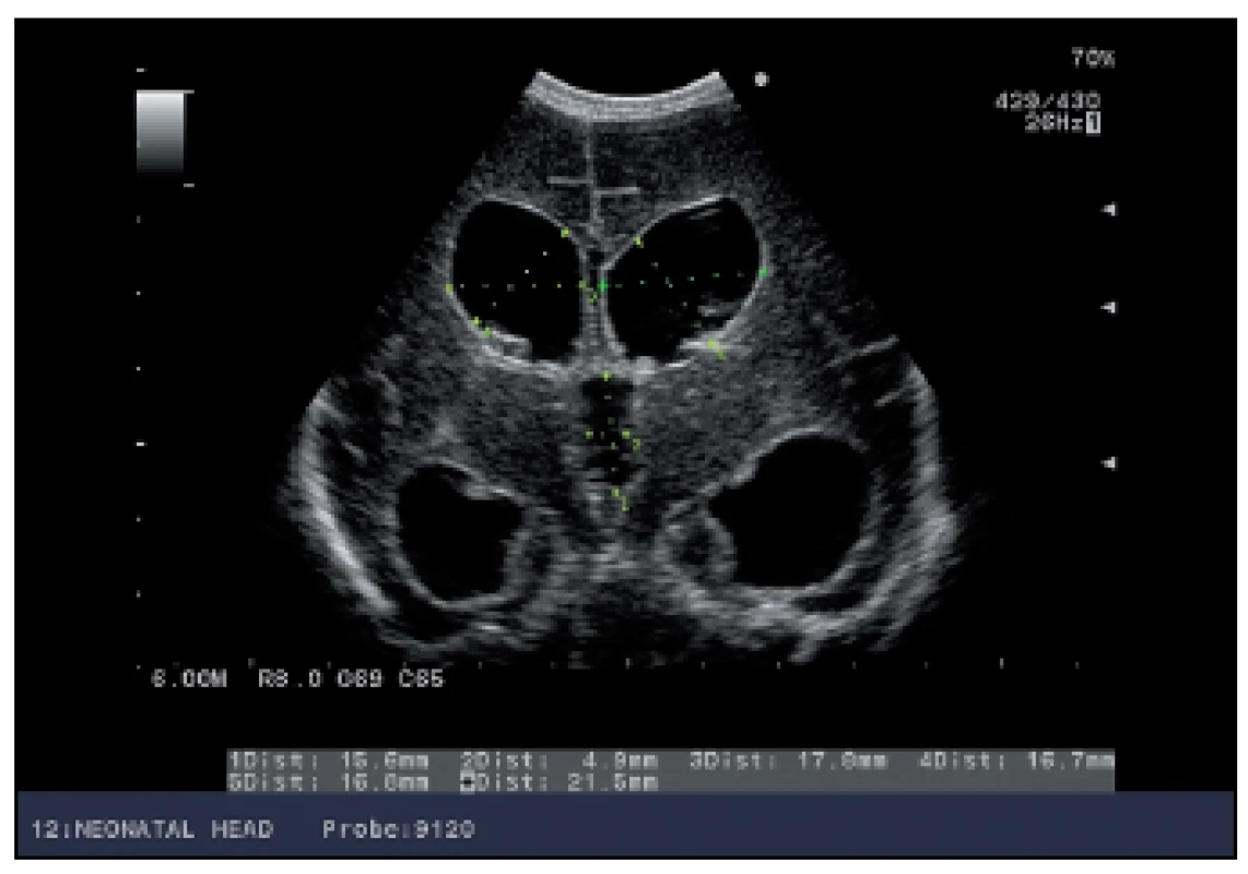 USG morfometria mozgových komôr u novorodenca s progresívnym hydrocefalom – koronárny rez.
Fig. 1. USG morphometry of brain chambers in a newborn with progressive hydrocephalus – coronary section.