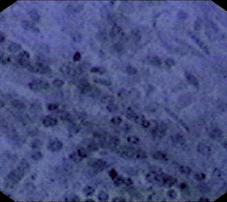 Endocytoskopický obraz karcinomu kolon