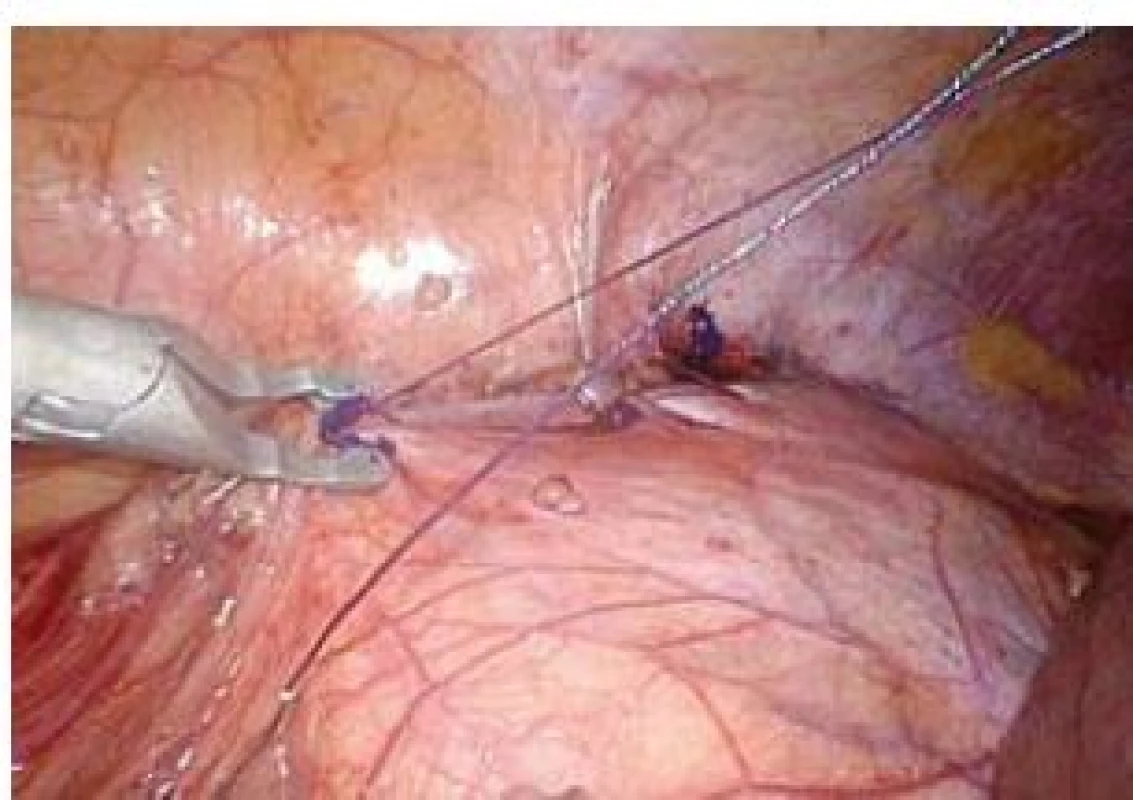 Peritoneum je uzavíráno pokračujícím polyglaktinovým stehem kotveným pomocí PDS klipů
Fig. 7. Peritoneum is closed with running suture (polyglactine) anchored with PDS clips