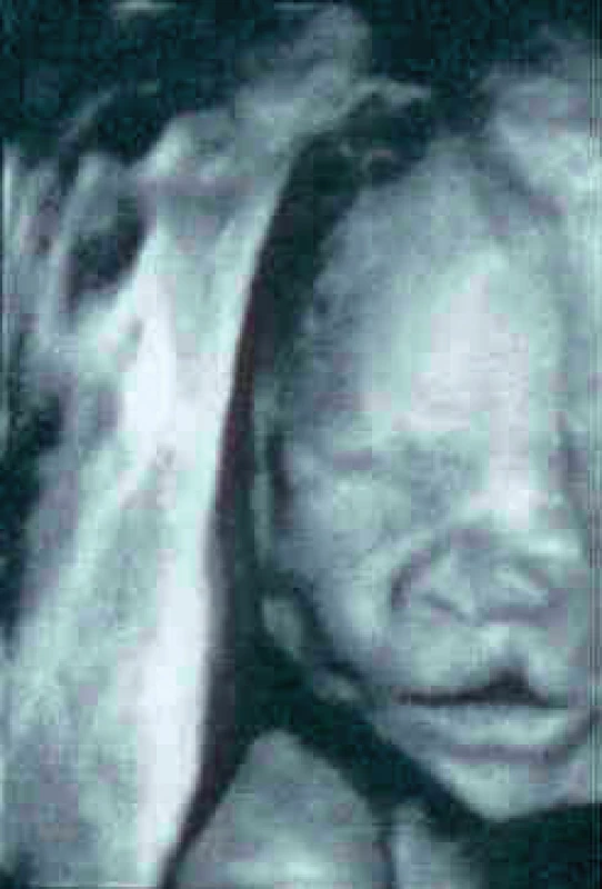 Ultrazvuková prenatální diagnostika levostranného rozštěpu rtu velikosti 2,2 mm u plodu v 21. týdnu těhotenství (MUDr. K. Čutka, Centrum lékařské genetiky, České Budějovice)