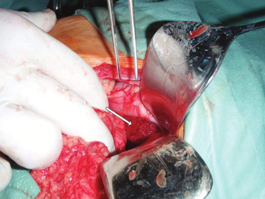 Operace, uložení cysty
Fig. 3: Surgery, localization of the cyst