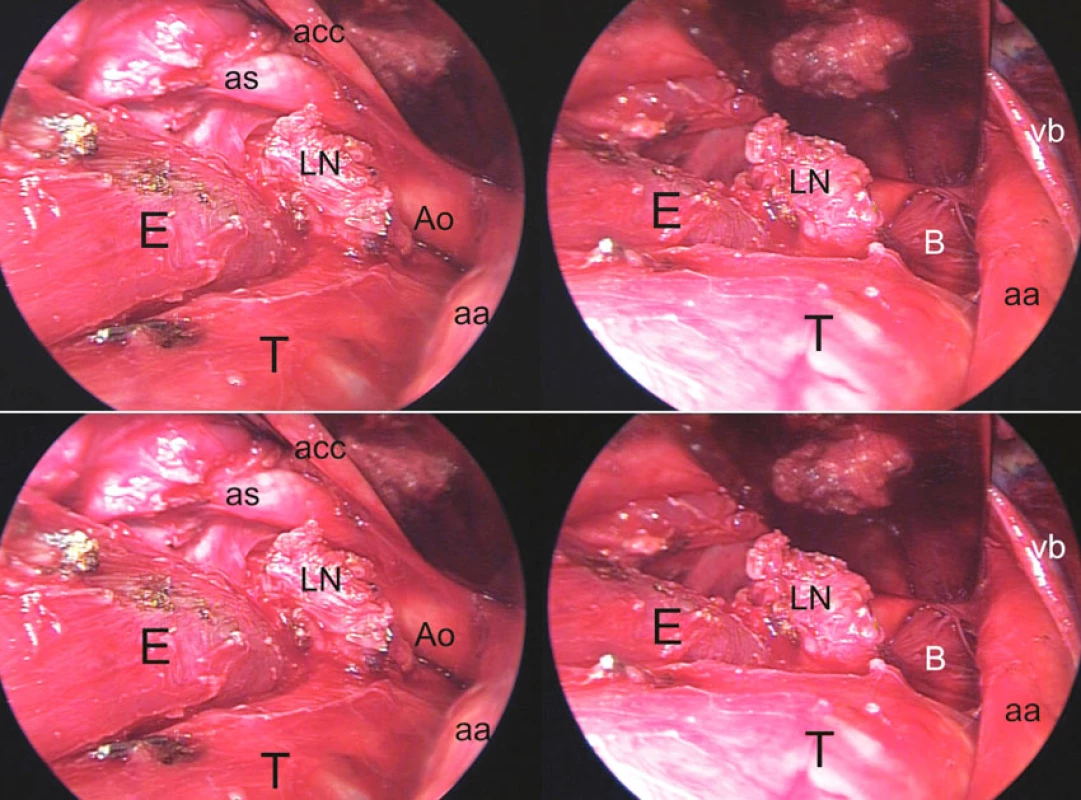 Preparácia proximálnej polovice pažeráka z transcervikálneho prístupu s retrakciou sterna, identického s transcervikálnou mediastinálnou lympfadenektómiou (TEMLA). E – pažerák, T – trachea, LN – paket uzlín nasadajúci na stenu pažeráka, oddelený od odstupu ľavej a. subclavia (as) z aortálneho oblúka (Ao), acc – a. carotis communis sin., aa – a. anonyma, B – bronchus principalis sin., vb – v. brachiocephalica sin. Vľavo: stav po oddelení paketu uzlín od odstupov a. carotis communis sin. a a. subclavia sin. Vpravo: ľavý hlavný bronchus viditeľný po retrakcii aortálneho oblúka ventrálne.
Fig. 6. Preparation of the proximal half of the esophagus from the transcervical approach with retraction of the sternum, identical with the transcervical extended mediastinal lymphadenectomy (TEMLA) technique. E – esophagus, T – trachea, LN – lymph nodes close to the esophageal wall, separated from the left subclavian artery branching (as) from the aortic arch (Ao), acc – a. carotis communis sin., aa – a. anonyma, B – bronchus principalis sin., vb – v. brachiocephalica sin. Left: the condition following removal of the lymph nodes from the branching sites of the a. carotis communis sin. and a. subclavia sin. Right: the left main bronchus after anterior retraction of the aortic arch
