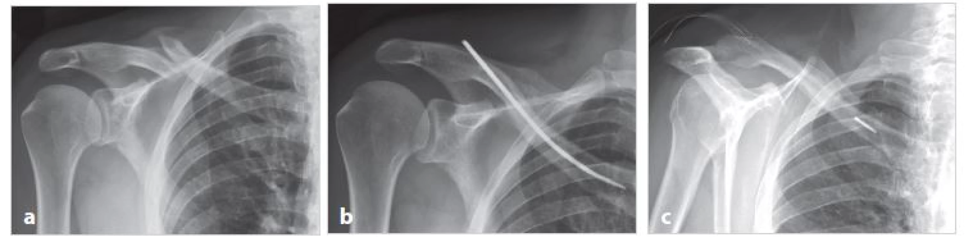 Dobré hojení zlomeniny a zlomení implantátu při jeho extrakci (muž T. E., 59 let)
a) úrazové snímky dvoufragmentové zlomeniny; b) pět měsíců po operaci zlomenina zhojena v anatomickém postavení; c) šest měsíců po operaci došlo při extrakci implantátu k odlomení jeho mediální části, která ponechána in situ
Fig. 3: Good healing of fracture and breakage of implant during its extraction (male T.E., 59 years)
a) X-ray of a two-fragment fracture taken after the injury; b) five months after surgery, the fracture is healed in anatomical position;
c) six months after the surgery, the implant was broken during its extraction, the medial part of pin was left in the bone