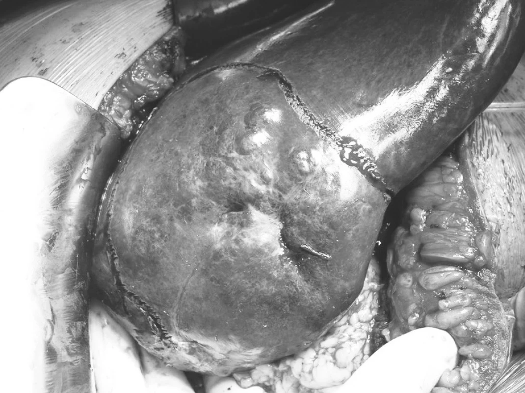 Kavernózní hemangiom pravého laloku jater před enukleací – elektrokoagulací vyznačená linie enukleace
Pic. 3. Cavernous hemangioma of the right liver lobe prior to enucleation – electrocoagulated enucleation line